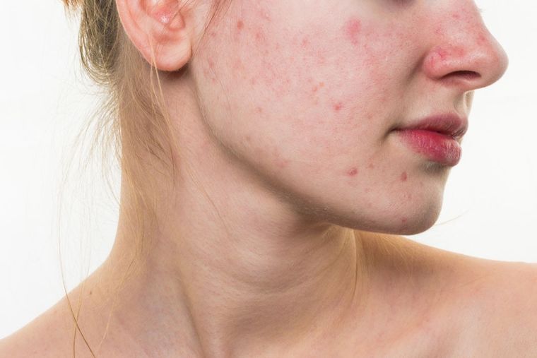 ¡Adiós marcas de acné!