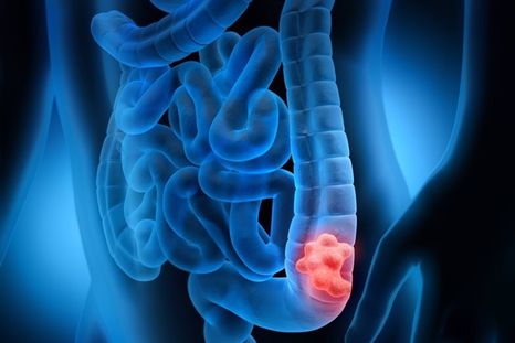 Existen distintas pruebas efectivas para detectar a tiempo el cáncer de colon. Foto: Archivo MDZ Existen distintas pruebas efectivas para detectar a tiempo el cáncer de colon. Foto: Archivo MDZ