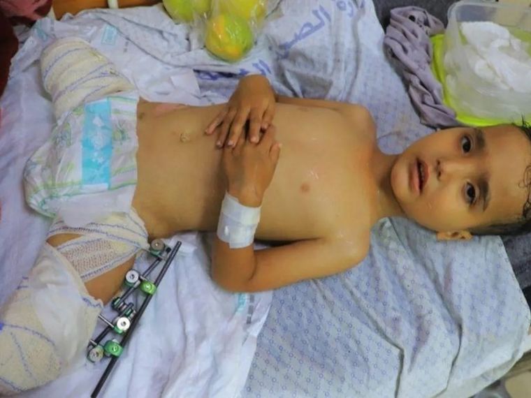 Ahmed Shabat, de 3 años, perdió sus piernas en una explosión en Gaza Foto: BBC