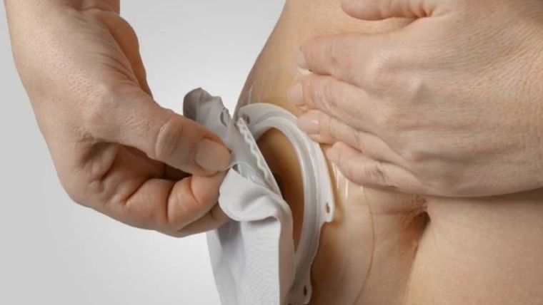Los pacientes ostomizados son personas sanas. Foto: Gentileza