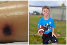 murio despues de que una extrana marca apareciera en su pierna