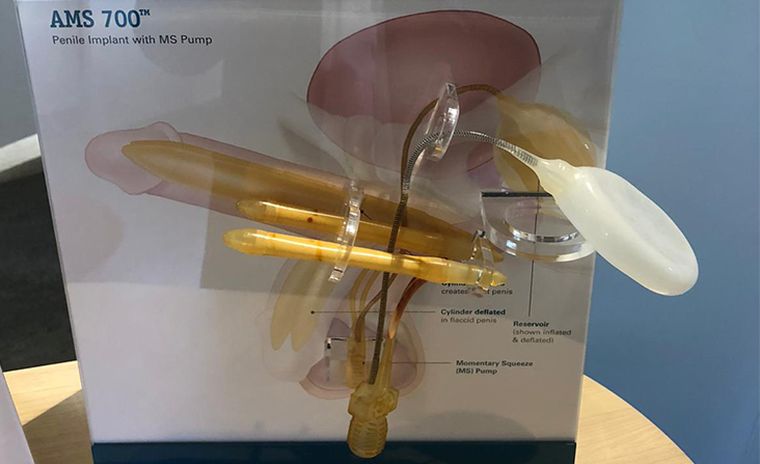 Ejemplo de implante inflable de pene. Ejemplo de implante inflable de pene.