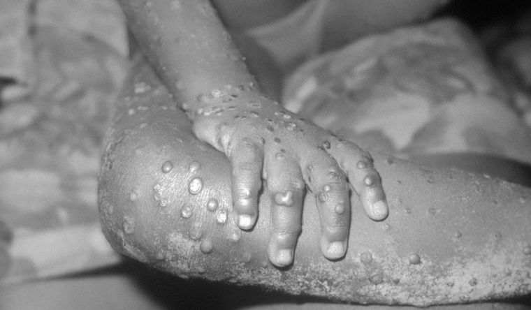 Lesiones en seres humanos producidas por la viruela símica. Foto: Wikipedia.