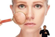 Existen dos tipos de cáncer de piel más comunes y estos son el carcinoma basocelular y el carcinoma espinocelular Foto: Foto gentileza: Youtube