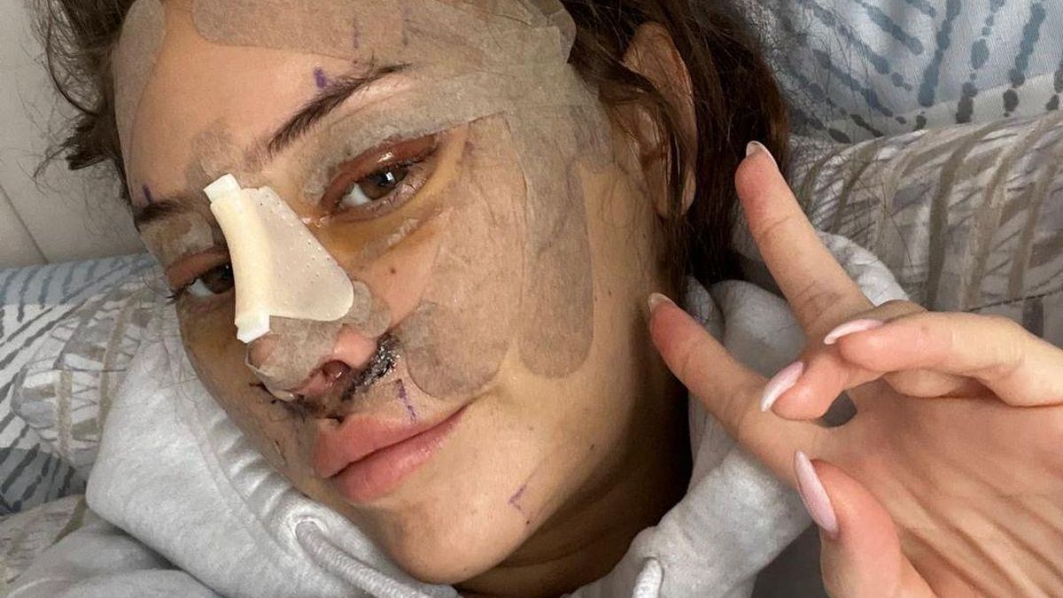 ¿Un "lifting" a los 28? Por qué cada vez hay más jóvenes que recurren a la cirugía plástica