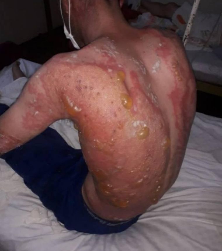 Dolor Leo cuenta que tiene que dormir boca arriba por los dolores.