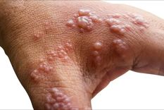 El Gobierno informó que ya son 5 los infectados con viruela del mono Foto: The Health Site