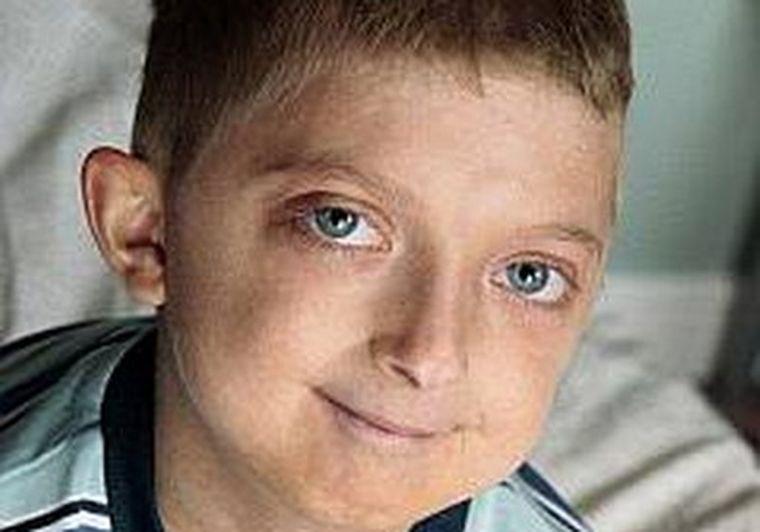 También conocida como el síndrome de Hutchinson-Gilford, es una condición genética rara y mortal. Foto: Gentileza / Docsalud.com