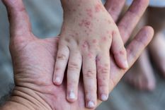 Mano-pie-boca es una enfermedad provocada por un contagioso virus. Foto: Shutterstock