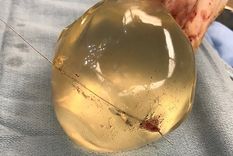 increible: una bala iba a su corazon, pero la detuvo el implante mamario