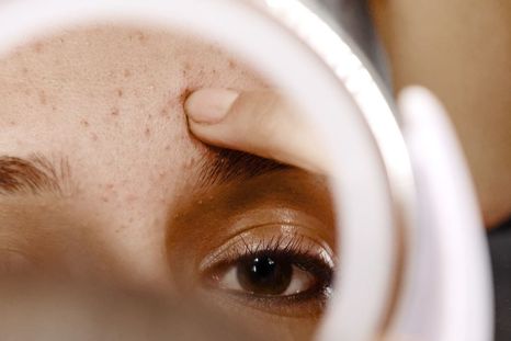 Acné en adultos: ¿por qué persiste aunque no seamos adolescentes? Foto: Eucerin