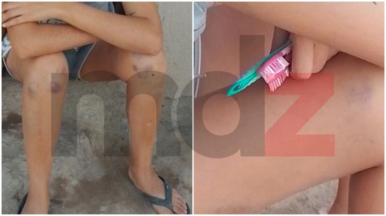 Las lesiones que sufrió la expareja de Alaniz en la agresión perpetrada en 2023. Las lesiones que sufrió la expareja de Alaniz en la agresión perpetrada en 2023.