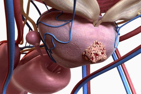 El 70% de los hombres no se realiza los controles hasta que no presentan síntomas de cáncer de próstata. El 70% de los hombres no se realiza los controles hasta que no presentan síntomas de cáncer de próstata.