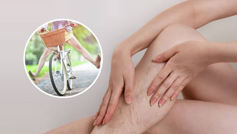 Con qué ejercicios combatimos las várices (Shutterstock).