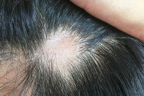 La caída del cabello causada por el coronavirus suele ser temporal. Foto: GETTY IMAGES