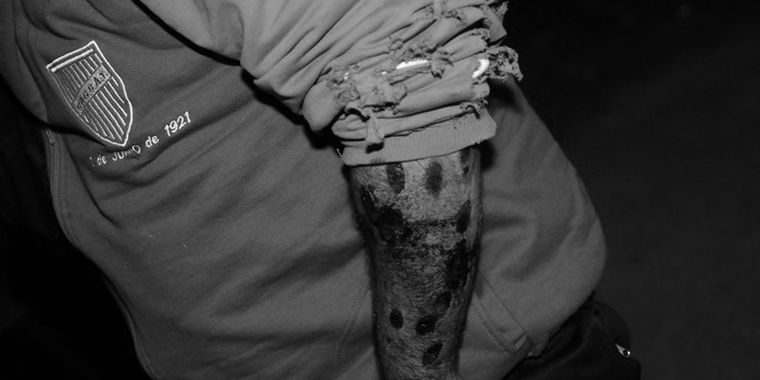 Un hincha baleado con proyectiles de goma en Jocolí. Foto: Pachy Reynoso / MDZ