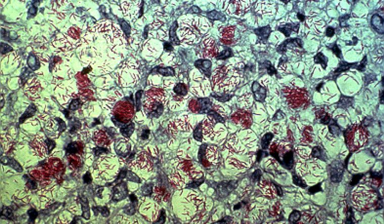 La bacteria de la lepra, llamada mycobacterium leprae, presente en el descubrimiento. Foto: Wikipedia La bacteria de la lepra, llamada mycobacterium leprae, presente en el descubrimiento. Foto: Wikipedia