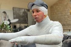 La foto de Instagram de Olivier Rousteing muestra las lesiones que sufrió el año pasado, dijo el diseñador. Foto: INSTAGRAM/OLIVIER ROUSTEING