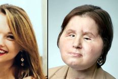 El histórico trasplante de rostro que le dio una segunda oportunidad a una joven que intentó suicidarse