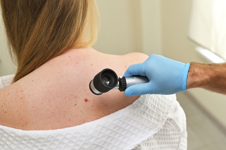 Una de las herramientas más eficaces para diagnosticar el melanoma en estadios iniciales es la observación atenta de la piel, sobre todo de los lunares. Foto: Shutterstock