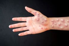 Los dos nuevos casos de mpox corresponden a personas de 46 y 28 años con antecedentes de viajes al exterior. Foto: Shutterstock
