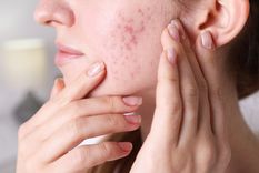 Acne Un sueño vinculado a la autoestima. Foto: Fuente: Shutterstock