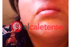 Serran exige una reconstrucción de sus fosas nasales desde agosto de 2021 Foto: El Caletense