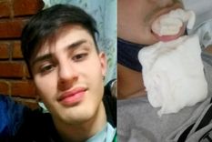 Facundo lleva 20 días esperando para que le coloquen cuatro placas de titanio tras un violento ataque en San Martín