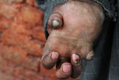 En 2019 se detectaron un total de 202.185 nuevos casos de la enfermedad en 120 países del mundo. Foto: Getty Images