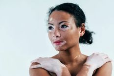 La condición es más notable en personas de piel oscura, pero afecta igualmente a todos los grupos étnicos. Foto: GETTY IMAGES