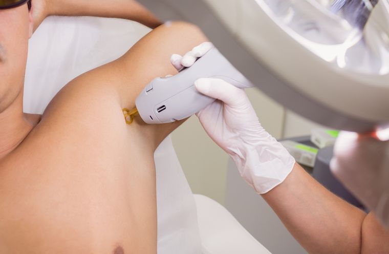 Anmat prohibió depiladoras laser Foto: Freepik