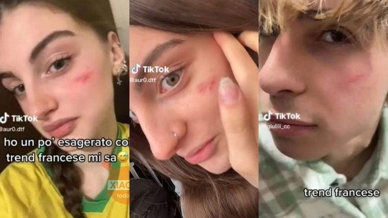 Cicatriz francesa Algunos jóvenes exhiben sus heridas en Tiktok. Foto: TikTok.