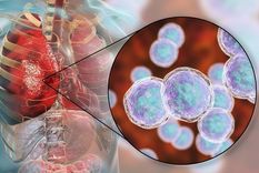 dia mundial contra la neumonia: como prevenir y tratar la enfermedad