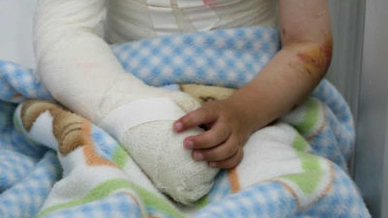 El niño está grave tras haberse quemado la mitad del cuerpo/Imagen Ilustrativa