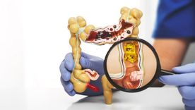 Por lo general los divertículos se desarrollan en el sigmoideo, la parte inferior izquierda del intestino grueso. Foto: Getty Images
