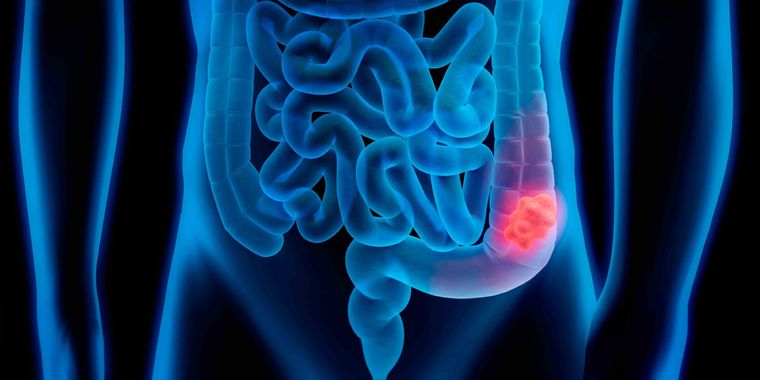 Los factores de riesgo para contraer un cáncer colorrectal son los antecedentes familiares y hereditarios Foto: Gentileza Cofa