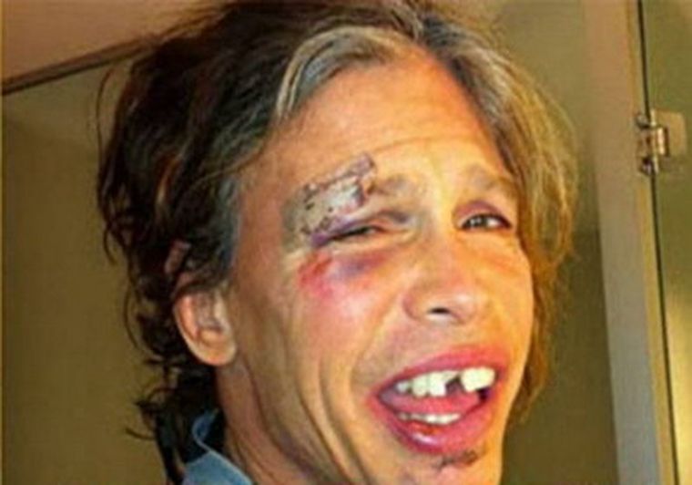 Así quedó Steven Tyler luego de la caída. Foto: Cedoc