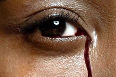 un caso muy extrano: una joven sangra por los ojos al menstruar