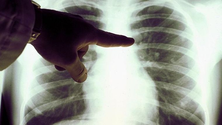 Sin medicación específica adicional, el linfoma de un paciente que contrajo el coronavirus desapareció, según una investigación. Foto: GETTY IMAGES