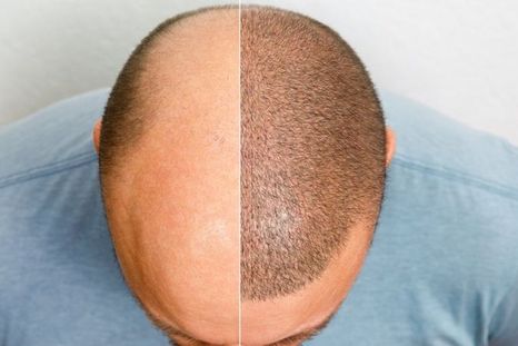 Chau calvicie: consejos de Harvard para recuperar el pelo Chau calvicie: consejos de Harvard para recuperar el pelo