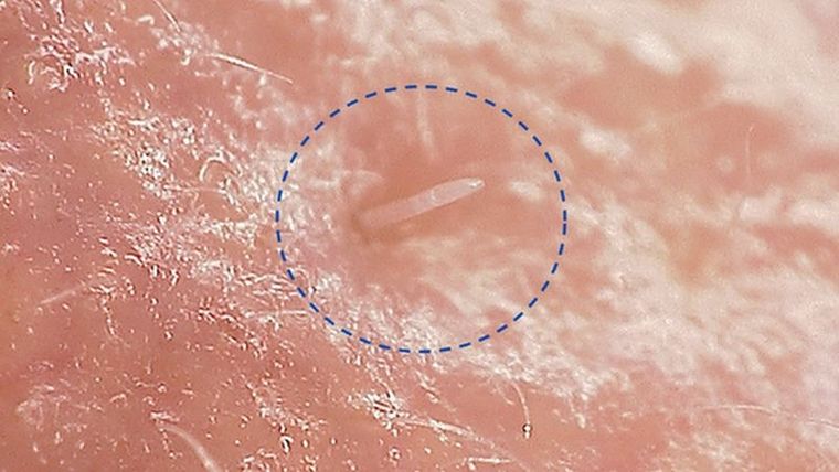 El Demodex follicularum, como se le llama científicamente, tiene solo 0,3 mm de largo Foto: UNIVERSITY OF READING
