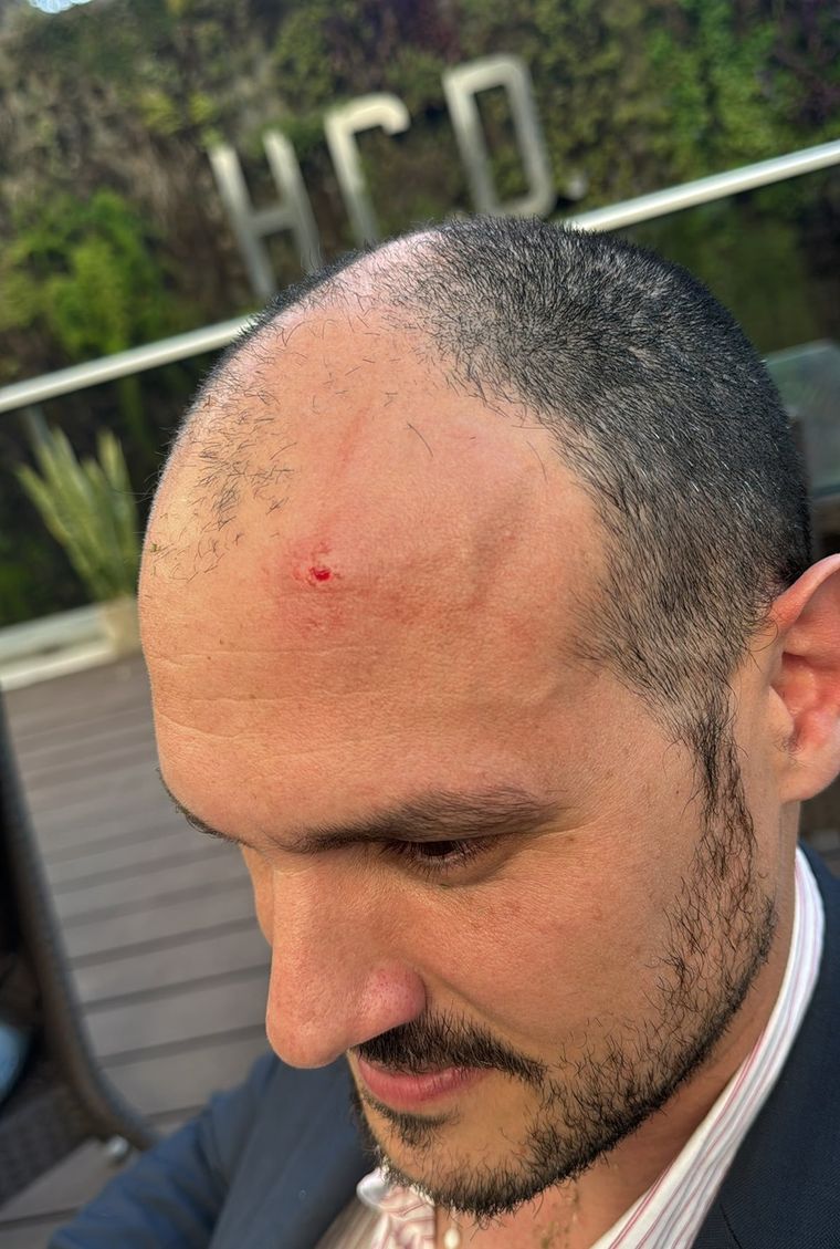 La cabeza de Santiago Santurio después del piedrazo