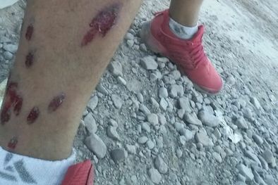 MDZol | democracia Daniel Alvarado (28) recibió ayer el impacto de varias balas de goma. Otros vecinos sostienen que hubo gases dentro del barrio.