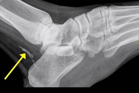 Pensó que tenía una infección pero el diagnóstico fue impactante