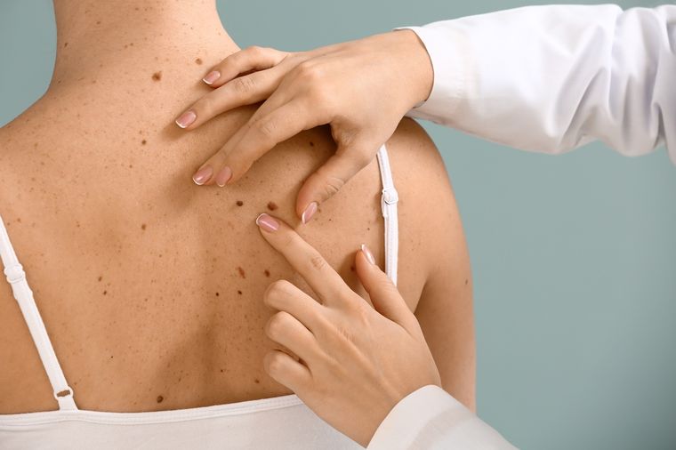 Los controles dermatológicos son clave para la identificación a tiempo de los tumores malignos de piel, como el melanoma, en más grave de todos. Foto: Shutterstock