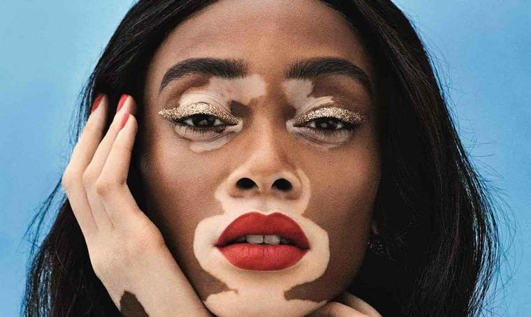 En el día mundial del vitíligo buscamos concientizar sobre esta enfermedad que afecta a la piel.