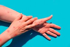 confirmaron la cantidad de argentinos contagiados de viruela del mono