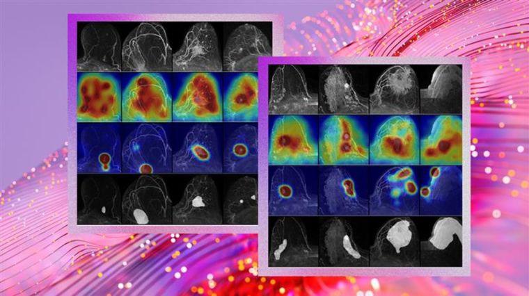 El modelo desarrollado mejora la precisión en la detección del cáncer de mama en entornos clínicos reales.