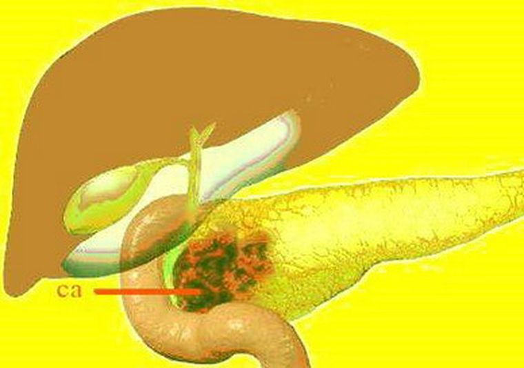 Los tumores del páncreas contienen, relativamente, pocos vasos sanguíneos.