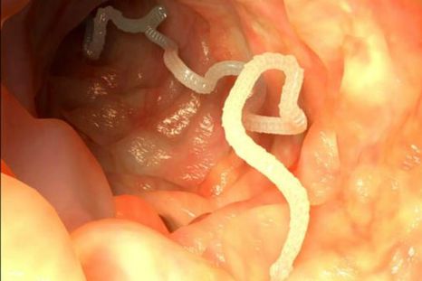 Receta para el reumatismo le trajo un enorme parásito en el pecho